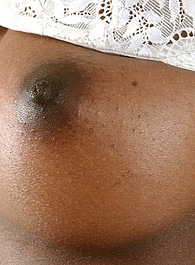 hairy balls